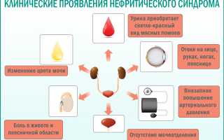 Нефритический синдром отличается от нефротического