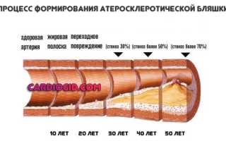 Перемежающуюся хромоту синдром шарко боль в ногах при ходьбе