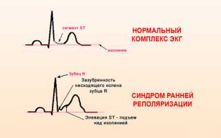 Синдром ранний реполяризации желудочков при беременности