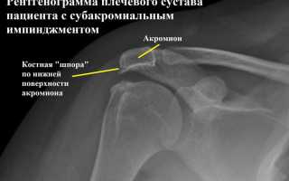 Импиджмент синдром плечевого сустава 2 степени