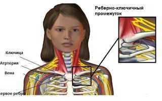 Скаленус синдром с обеих сторон