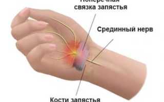 Синдром туннельного запястья при беременности лечение
