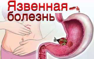 Код мкб цирроза печени
