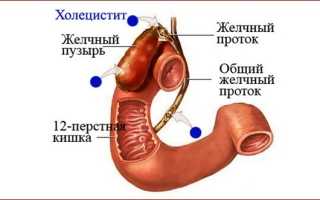Патологические синдромы поражения желчного пузыря