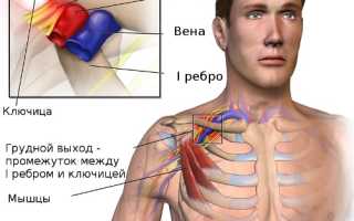 Синдрома выхода из грудной клетки