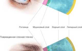 Синдром сухого глаза где лечить