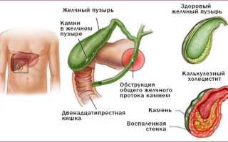 Холецистокардиальный синдром что это такое