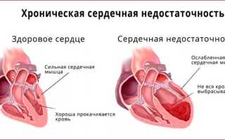 Синдром хронической сердечной недостаточности что это такое