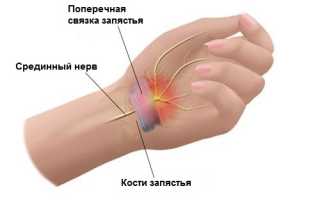 Комплекс упражнений при туннельном синдроме