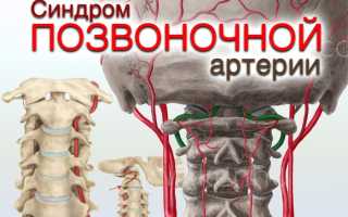 Лекарства при лечении синдрома позвоночной артерии