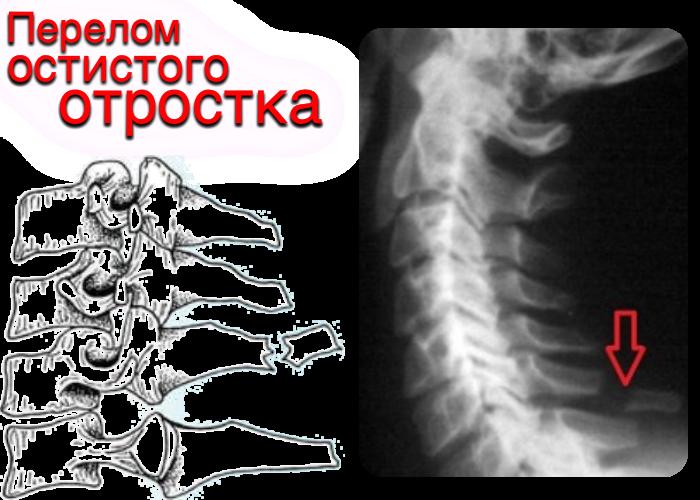 Перелом позвонка мкб код