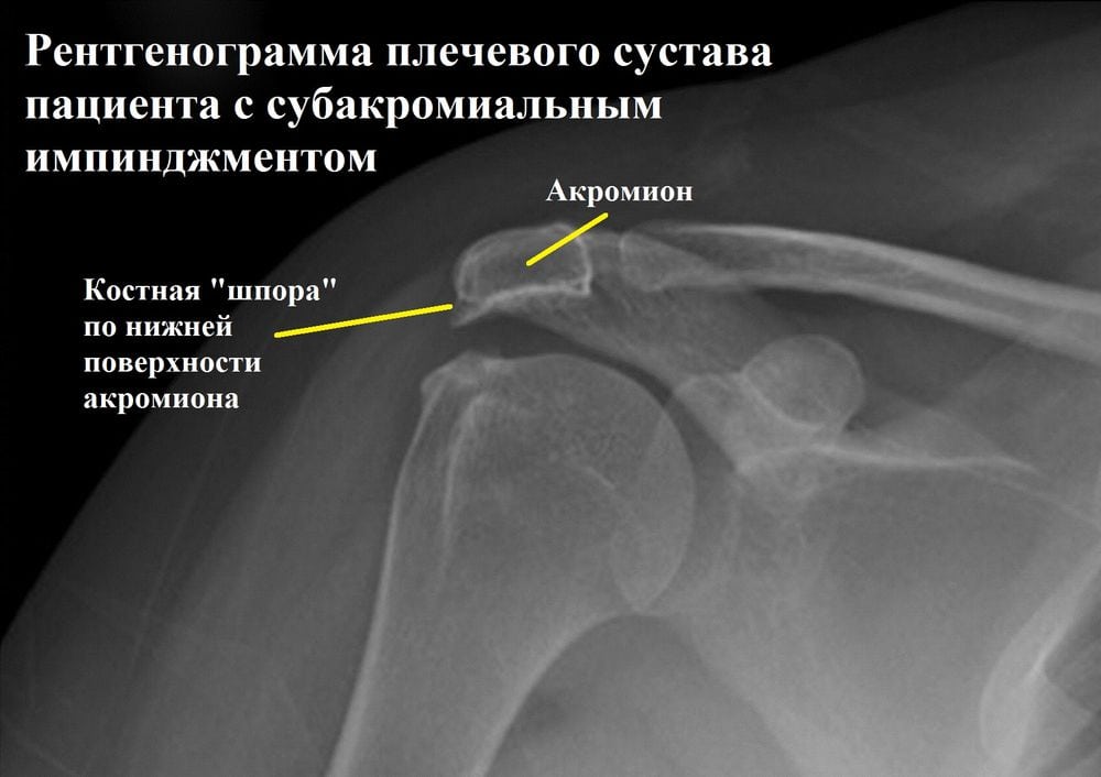 Импиджмент синдром плечевого сустава 2 степени