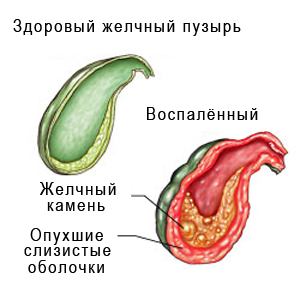 Zabolevaniya_pecheni_simptomy_i_priznaki_bolezni_zhelchnogo_puzyrya