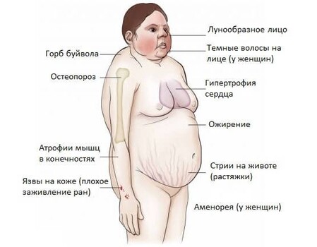 Фото людей с синдромом иценко кушинга