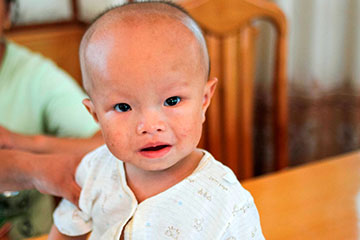 водянка мозга у детей