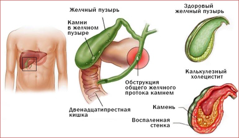 Камни в желчном пузыре