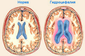 норма и гидроцефалия
