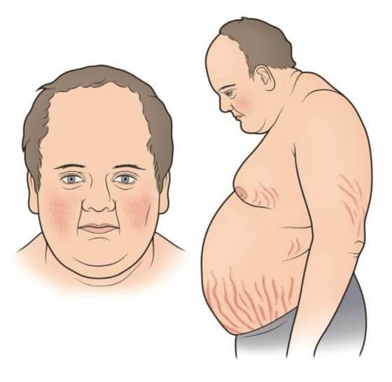 Фото людей с синдромом иценко кушинга