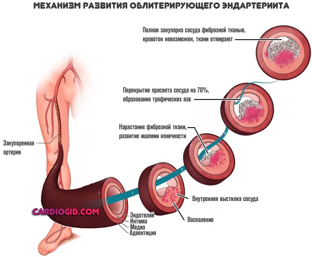 облитерирующий эндартериит