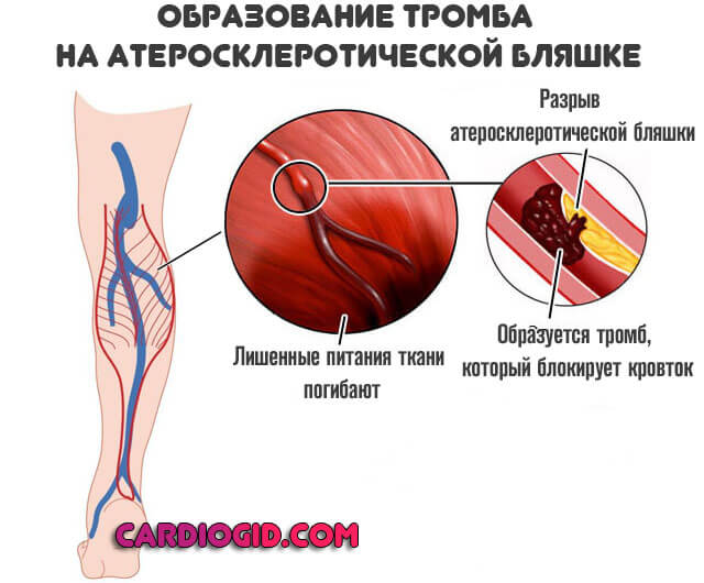 образование-тромба-на-атеросклеротической-бляшке