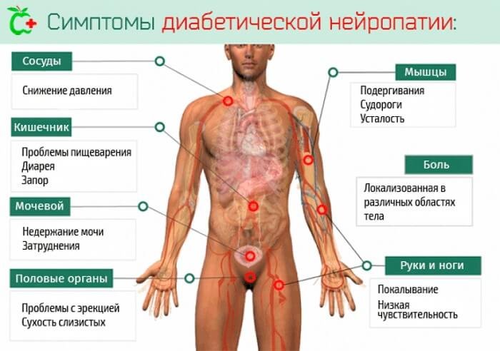 Симптомы нейропатии