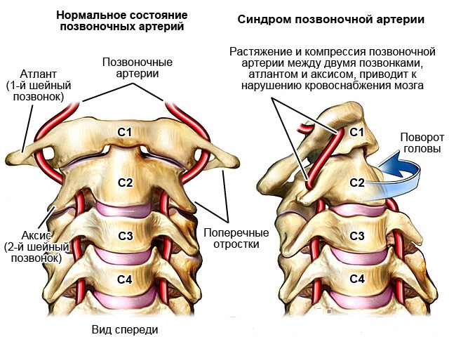 Синдром позвоночной артерии