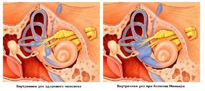 Меньероподобный синдром что это такое
